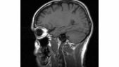 Scientists discover key gene in brain that may be responsible for autism